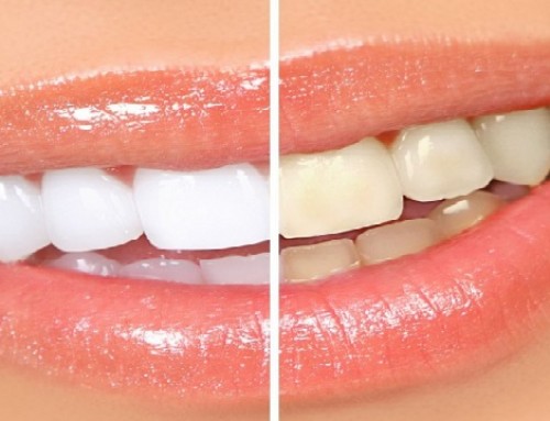 Clareamento Dental, seus Dentes mais Brancos e Lindos!