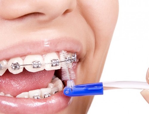 Como Cuidar do Aparelho Dental Fixo?